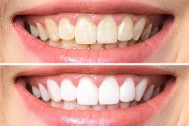 Gel blanqueador Dental, Pack 3 Gel blanqueador para el cuidado bucal, 3x3ml