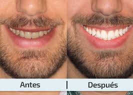 Lámpara LED para blanqueamiento Dental