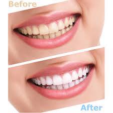 BLANQUEADOR DENTAL ELECTRÓNICO LUZ LED